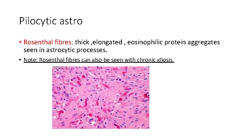 Pilocytic astro • Rosenthal fibres: thick , elongated , eosinophilic protein aggregates seen in Pilocytic astro • Rosenthal fibres: thick , elongated , eosinophilic protein aggregates seen in