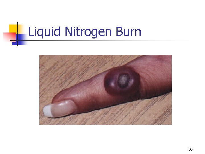 Liquid Nitrogen Burn 36 