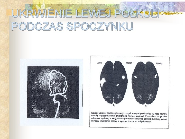 UKRWIENIE LEWEJ PÓŁKULI PODCZAS SPOCZYNKU UKRWIENIE LEWEJ PÓŁKULI PODCZAS SPOCZYNKU