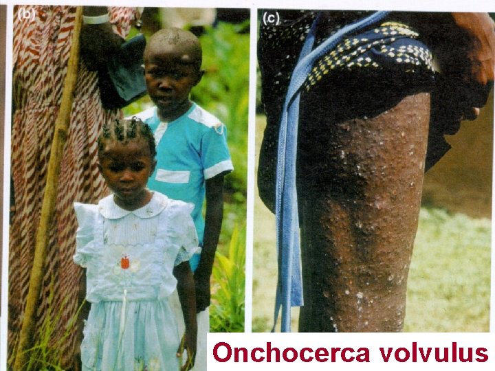 Onchocerca volvulus 