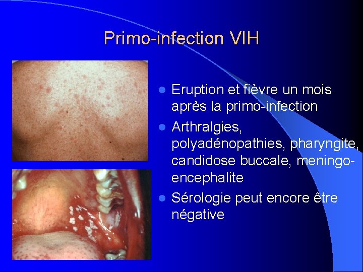 Primo-infection VIH Eruption et fièvre un mois après la primo-infection l Arthralgies, polyadénopathies, pharyngite,