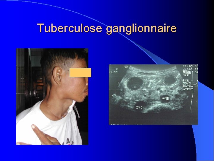 Tuberculose ganglionnaire 