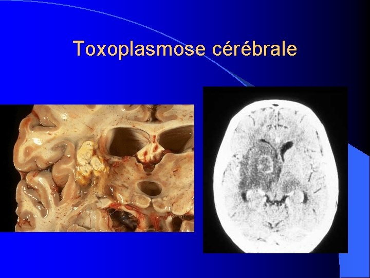 Toxoplasmose cérébrale 