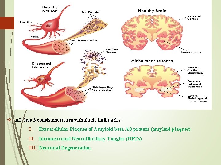 v AD has 3 consistent neuropathologic hallmarks: I. Extracellular Plaques of Amyloid beta Aβ