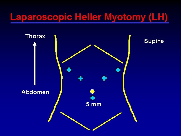 Laparoscopic Heller Myotomy (LH) Thorax Supine Abdomen 5 mm 