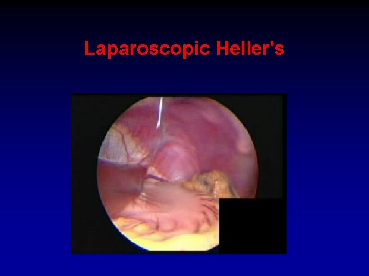 Laparoscopic Heller's 