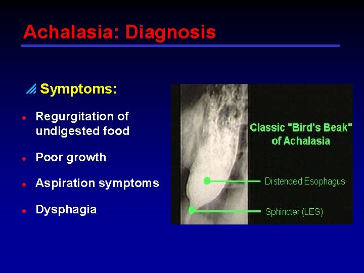 Achalasia: Diagnosis p Symptoms: l Regurgitation of undigested food l Poor growth l Aspiration