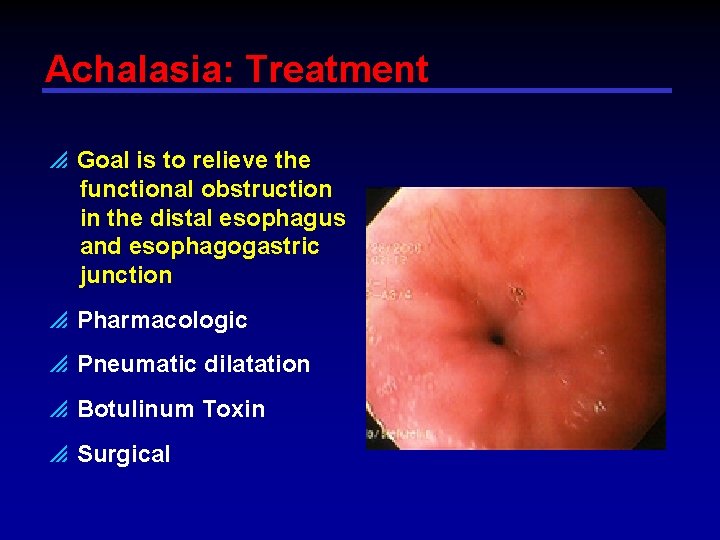 Achalasia: Treatment p Goal is to relieve the functional obstruction in the distal esophagus