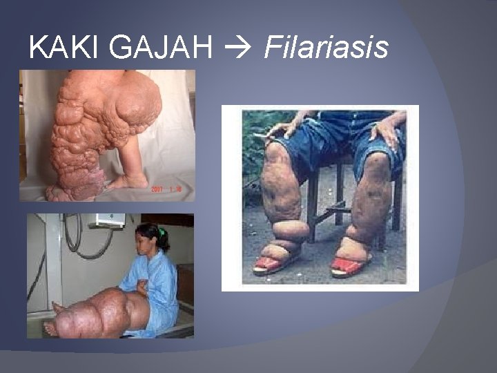 KAKI GAJAH Filariasis 