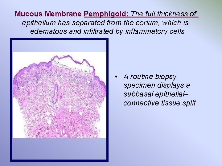Mucous Membrane Pemphigoid: The full thickness of epithelium has separated from the corium, which