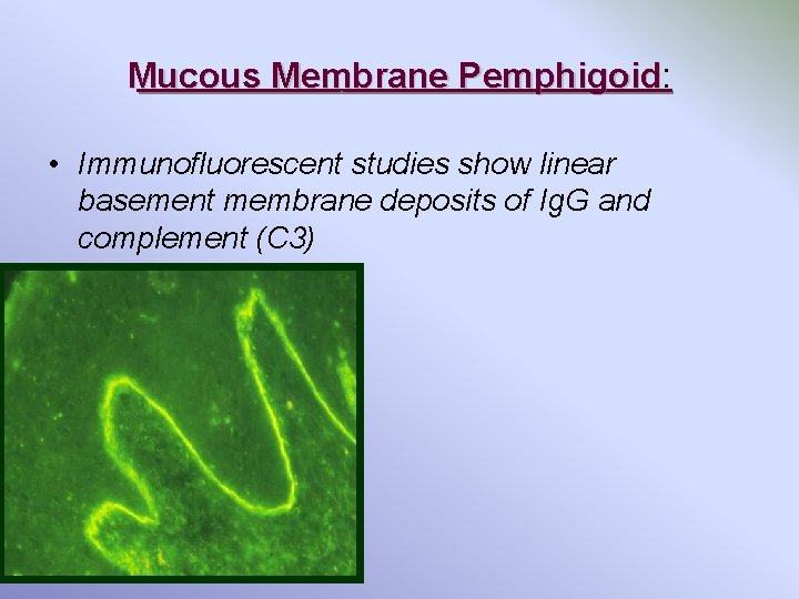 Mucous Membrane Pemphigoid: • Immunofluorescent studies show linear basement membrane deposits of Ig. G