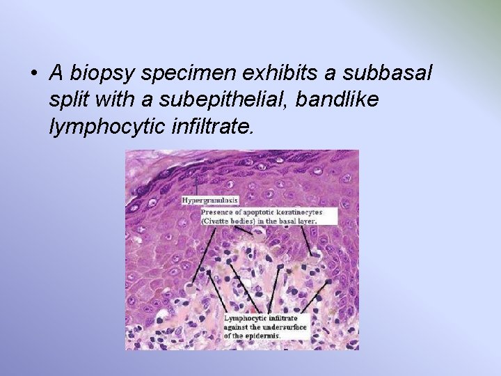  • A biopsy specimen exhibits a subbasal split with a subepithelial, bandlike lymphocytic