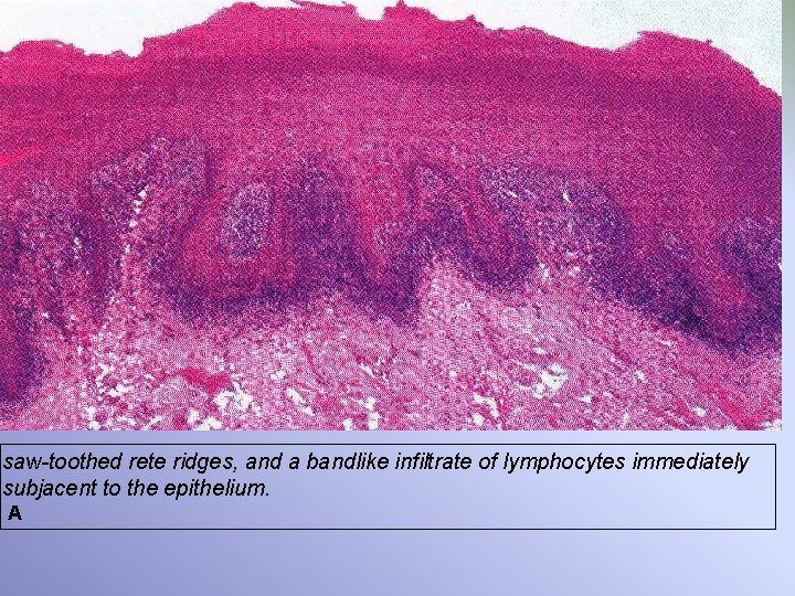 saw-toothed rete ridges, and a bandlike infiltrate of lymphocytes immediately subjacent to the epithelium.
