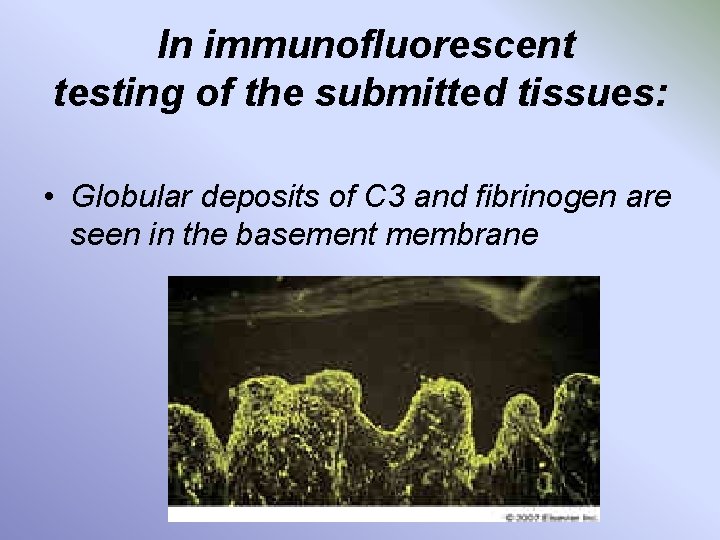 In immunofluorescent testing of the submitted tissues: • Globular deposits of C 3 and