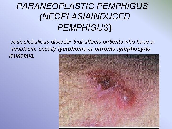 PARANEOPLASTIC PEMPHIGUS (NEOPLASIAINDUCED PEMPHIGUS) vesiculobullous disorder that affects patients who have a neoplasm, usually
