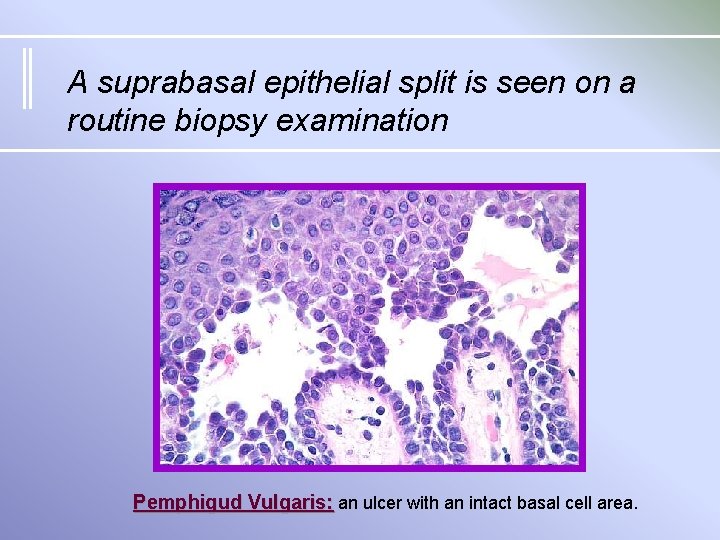 A suprabasal epithelial split is seen on a routine biopsy examination Pemphigud Vulgaris: an