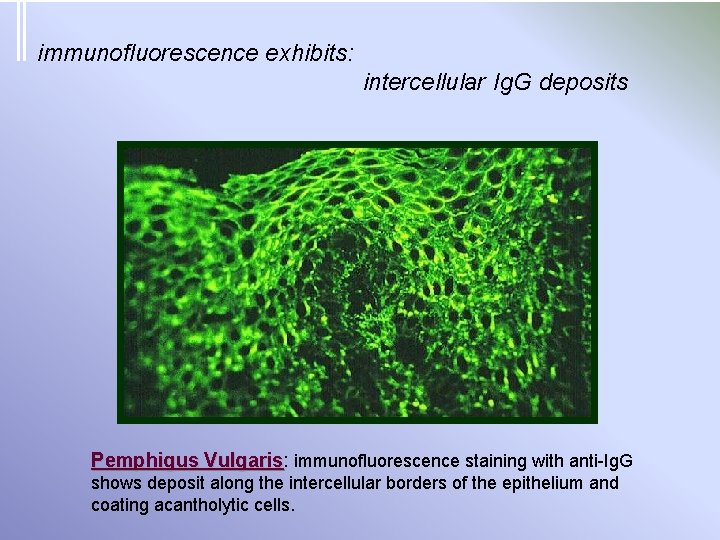 immunofluorescence exhibits: intercellular Ig. G deposits Pemphigus Vulgaris: Vulgaris immunofluorescence staining with anti-Ig. G