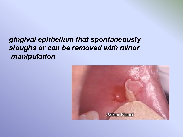 gingival epithelium that spontaneously sloughs or can be removed with minor manipulation 