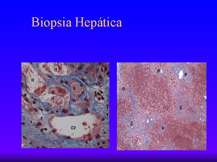 Biopsia Hepática 