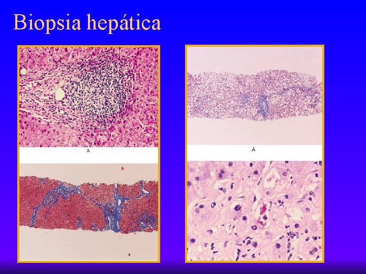 Biopsia hepática 