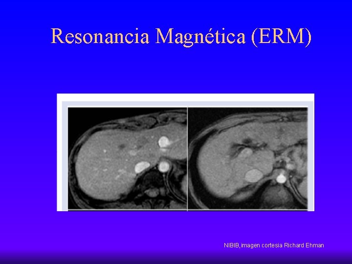 Resonancia Magnética (ERM) NIBIB, imagen cortesia Richard Ehman 