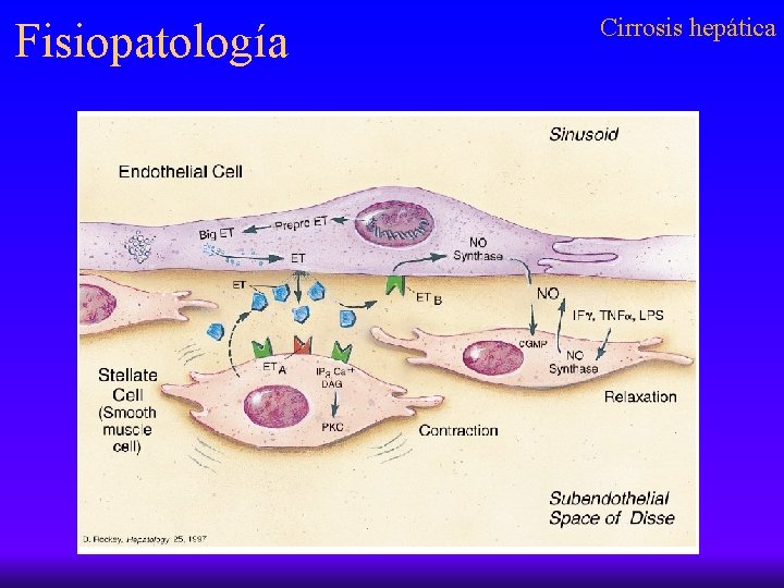 Fisiopatología Cirrosis hepática 