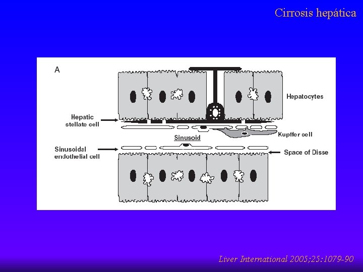 Cirrosis hepática Liver International 2005; 25: 1079 -90 