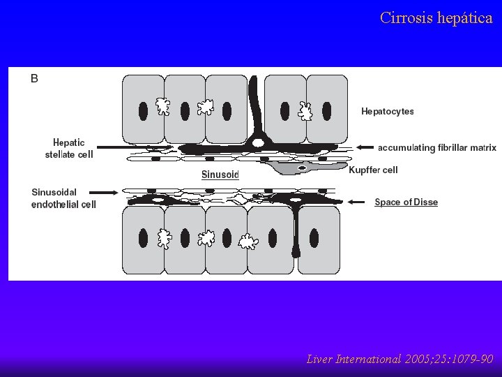 Cirrosis hepática Liver International 2005; 25: 1079 -90 