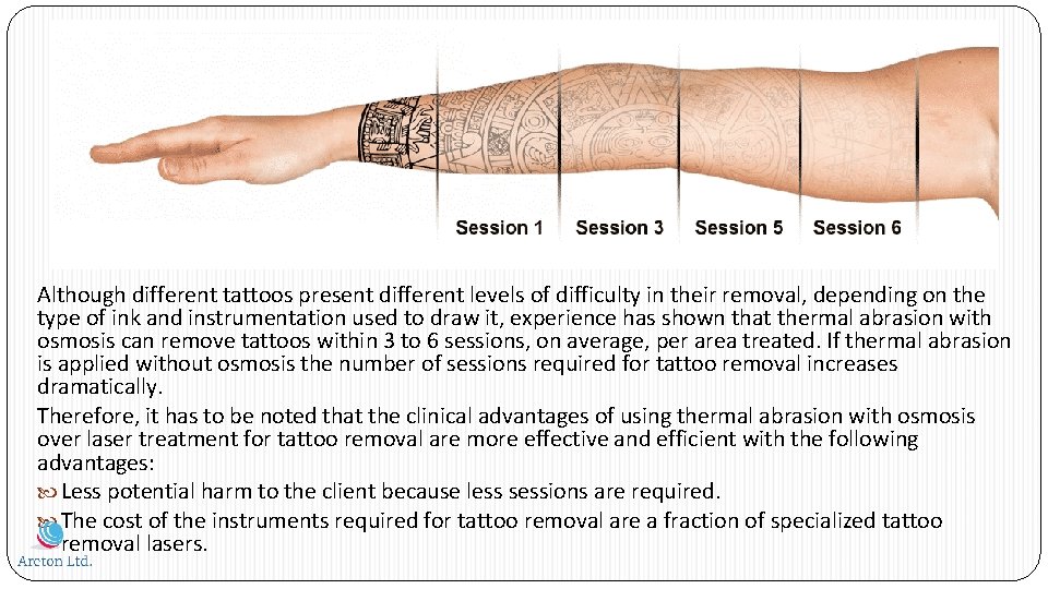 Although different tattoos present different levels of difficulty in their removal, depending on the