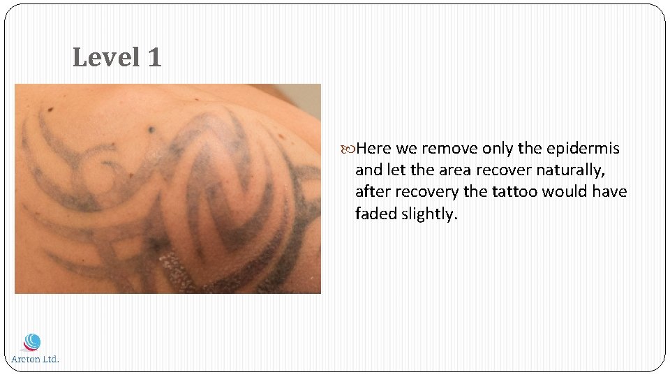 Level 1 Here we remove only the epidermis and let the area recover naturally,