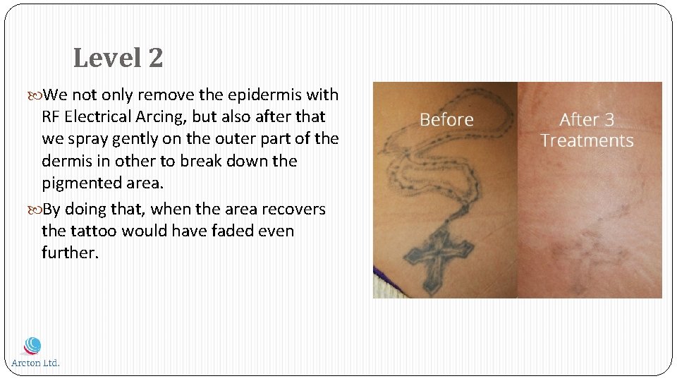 Level 2 We not only remove the epidermis with RF Electrical Arcing, but also