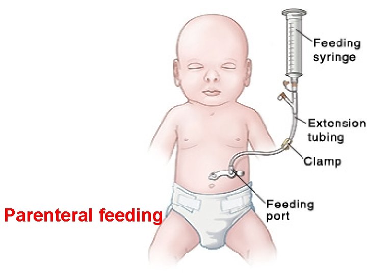 Parenteral feeding 