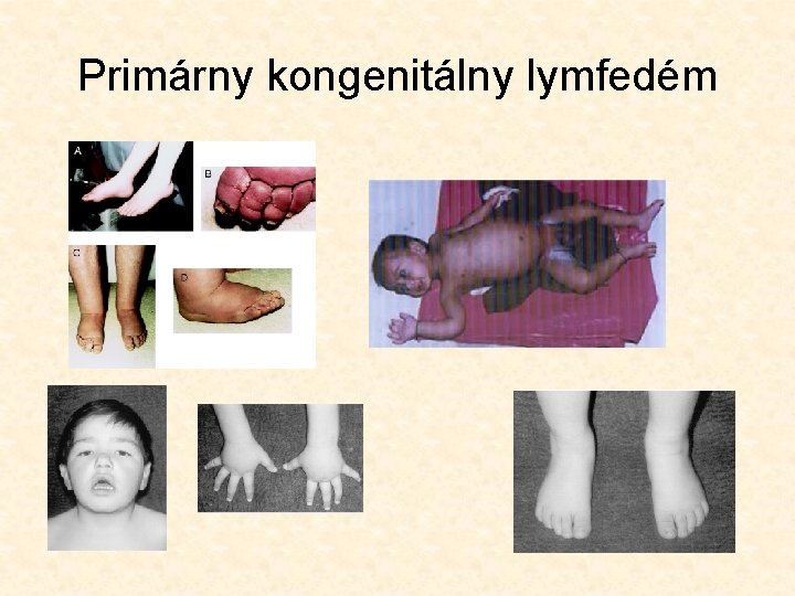 Primárny kongenitálny lymfedém 