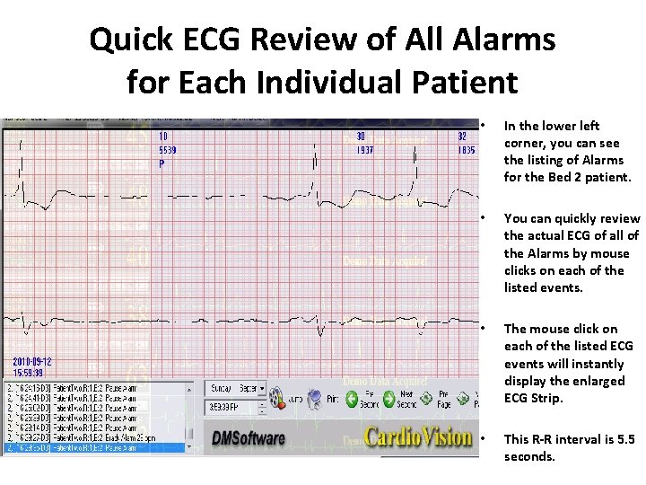 Quick ECG Review of All Alarms for Each Individual Patient • In the lower