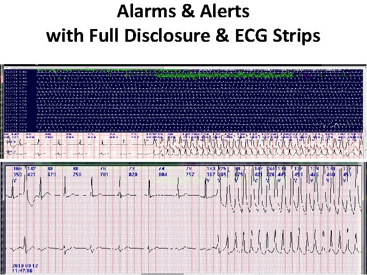 Alarms & Alerts with Full Disclosure & ECG Strips 