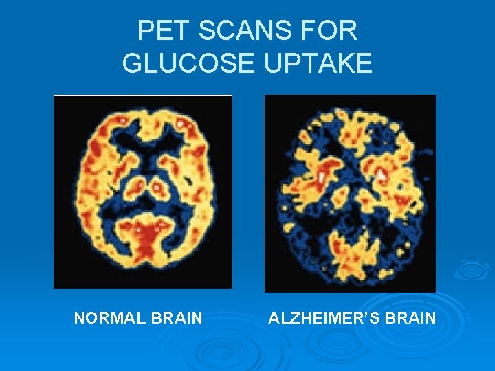 PET SCANS FOR GLUCOSE UPTAKE NORMAL BRAIN ALZHEIMER’S BRAIN 