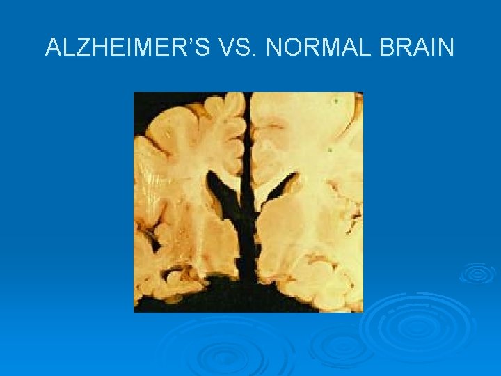 ALZHEIMER’S VS. NORMAL BRAIN 