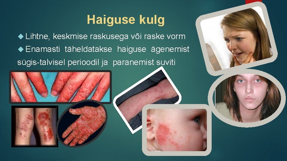 Haiguse kulg Lihtne, keskmise raskusega või raske vorm Enamasti täheldatakse haiguse ägenemist sügis-talvisel perioodil