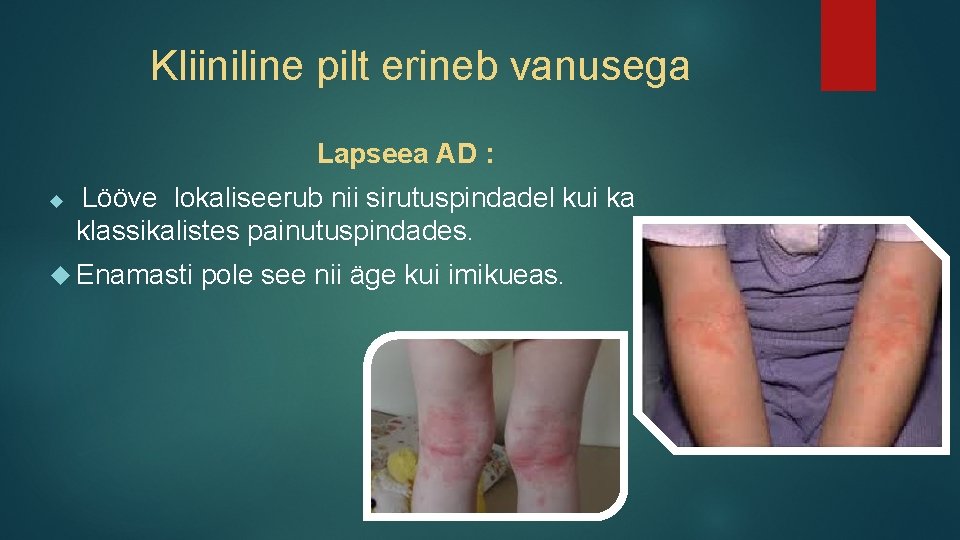 Kliiniline pilt erineb vanusega Lapseea AD : Lööve lokaliseerub nii sirutuspindadel kui ka klassikalistes