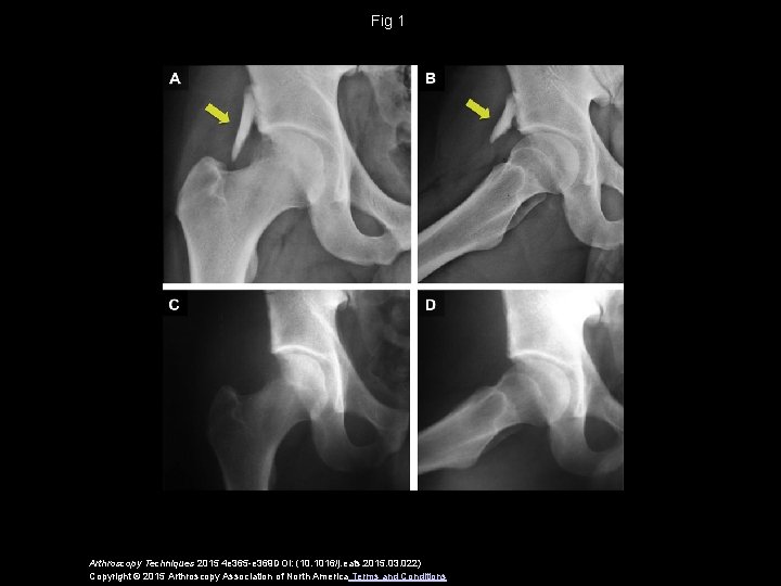 Fig 1 Arthroscopy Techniques 2015 4 e 365 -e 369 DOI: (10. 1016/j. eats.