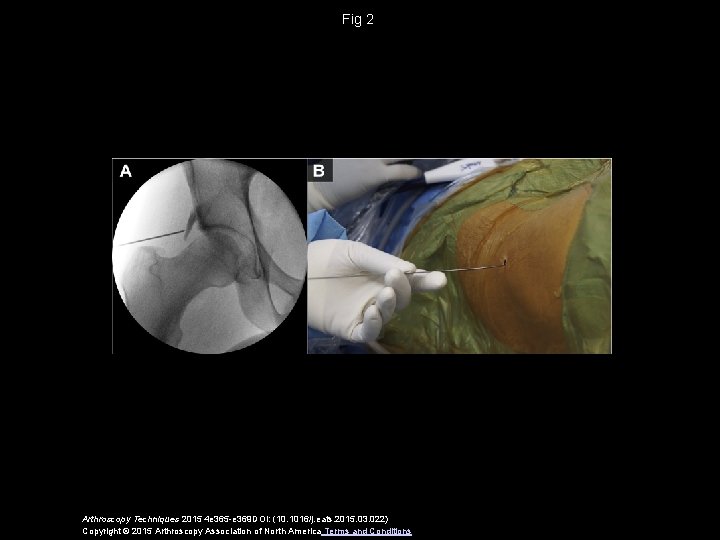 Fig 2 Arthroscopy Techniques 2015 4 e 365 -e 369 DOI: (10. 1016/j. eats.