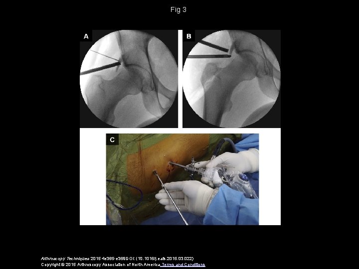 Fig 3 Arthroscopy Techniques 2015 4 e 365 -e 369 DOI: (10. 1016/j. eats.