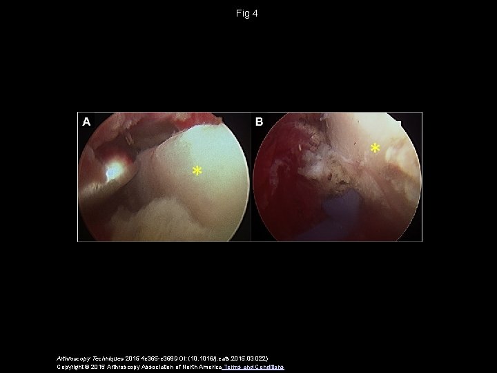Fig 4 Arthroscopy Techniques 2015 4 e 365 -e 369 DOI: (10. 1016/j. eats.