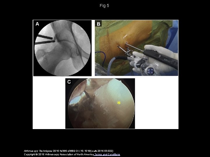 Fig 5 Arthroscopy Techniques 2015 4 e 365 -e 369 DOI: (10. 1016/j. eats.