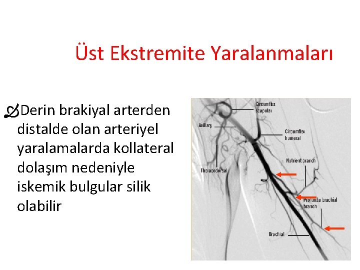 Üst Ekstremite Yaralanmaları Derin brakiyal arterden distalde olan arteriyel yaralamalarda kollateral dolaşım nedeniyle iskemik Üst Ekstremite Yaralanmaları Derin brakiyal arterden distalde olan arteriyel yaralamalarda kollateral dolaşım nedeniyle iskemik