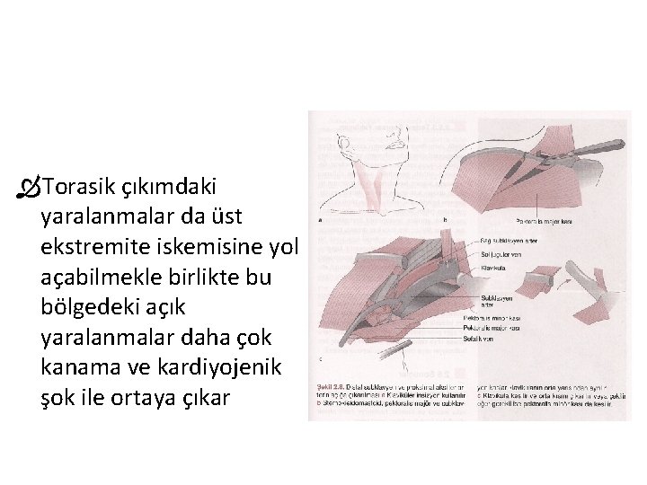 Torasik çıkımdaki yaralanmalar da üst ekstremite iskemisine yol açabilmekle birlikte bu bölgedeki açık Torasik çıkımdaki yaralanmalar da üst ekstremite iskemisine yol açabilmekle birlikte bu bölgedeki açık
