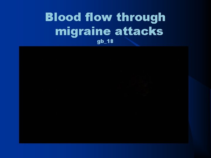 Blood flow through migraine attacks gb_18 