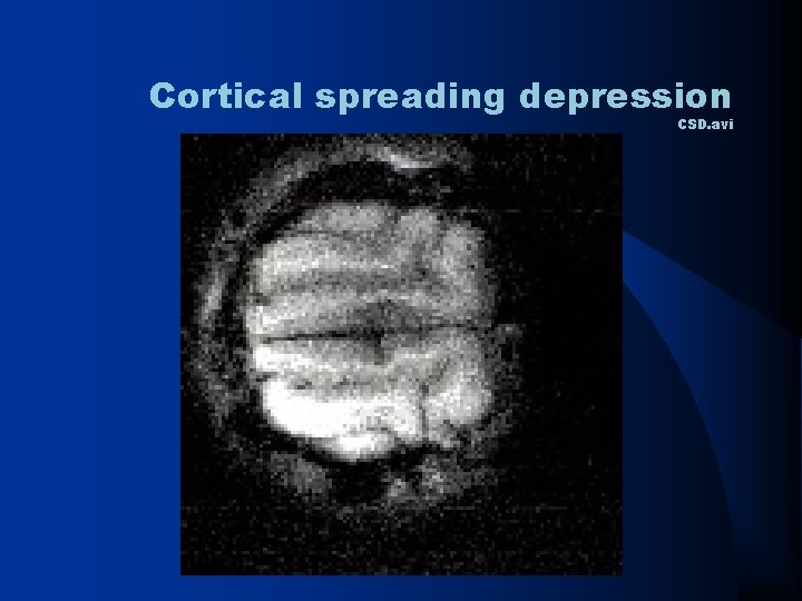 Cortical spreading depression CSD. avi 