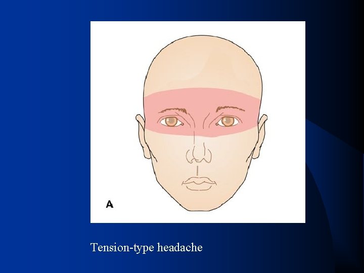 Tension-type headache 