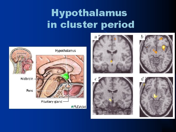 Hypothalamus in cluster period 